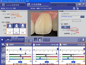 ホワイトニング